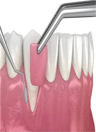 Flap Surgery (Periodontal Surgery)