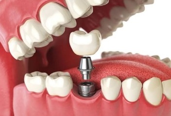 Dental Implants