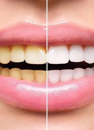 Teeth Whitening