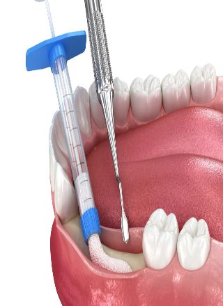 Bone Grafting / Regenerative Procedures