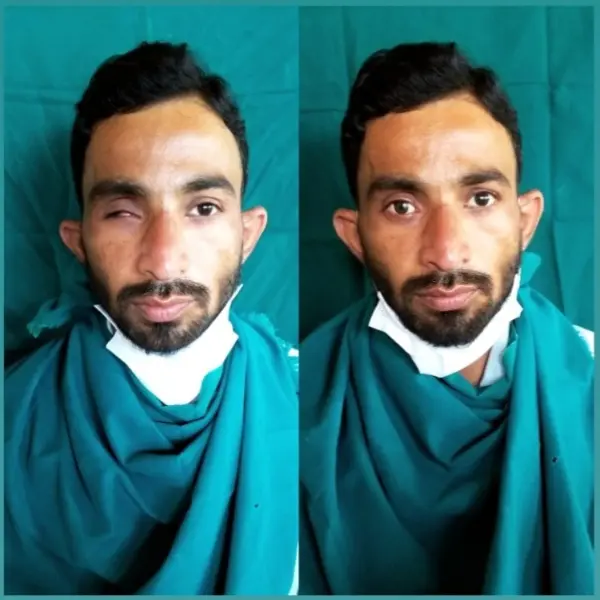 Prosthetic Rehabilitation Services in Viman Nagar, Pune