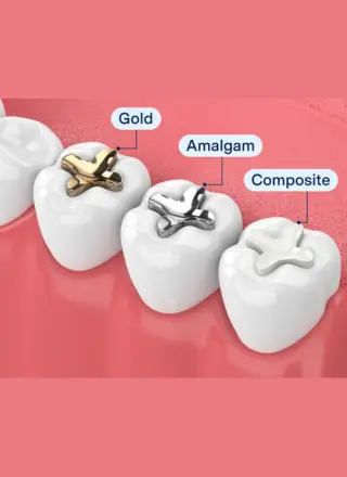 Dental Filling
