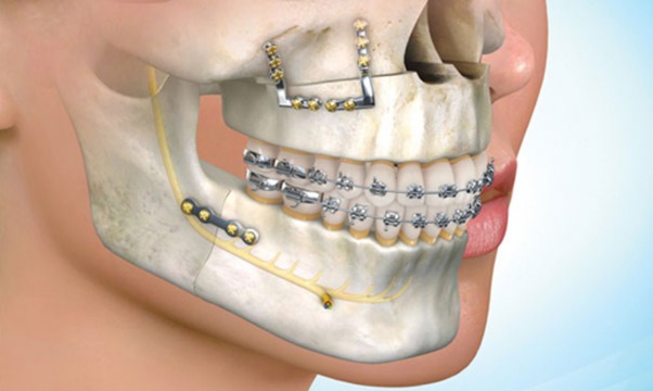 Maxillofacial and Facial Prosthetic Rehabilitation