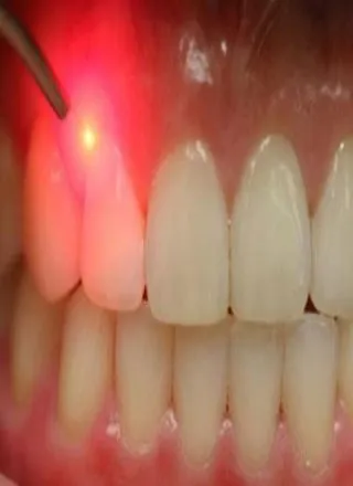 Laser Gum Treatment