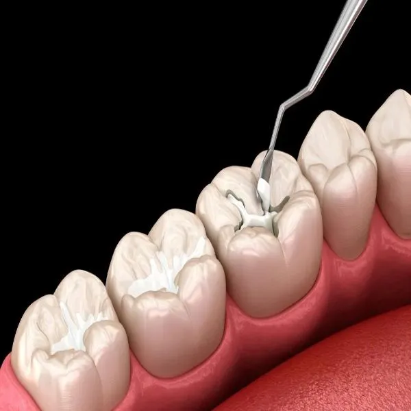 Dental Filling