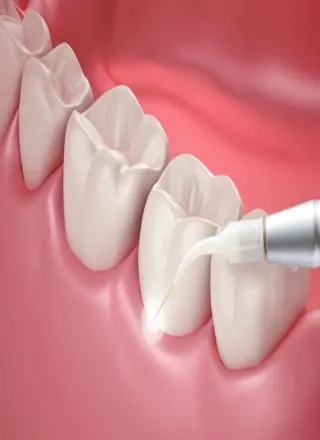 Crown Lengthening