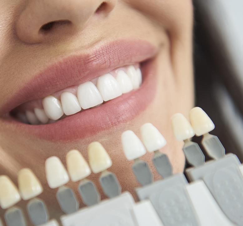 Dental Veneers