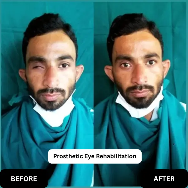Prosthetic Eye Rehabilitation