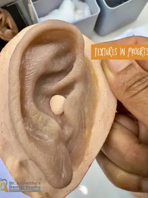 Finger Prosthetic Rehabilitation