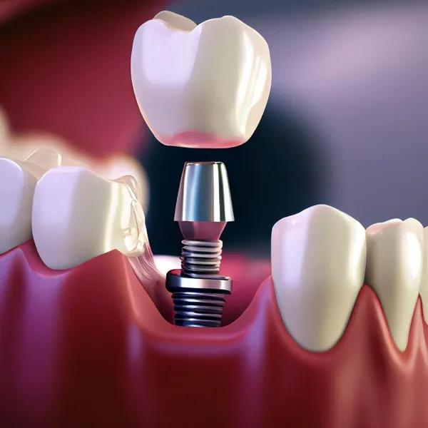 Dental Implant In Pune