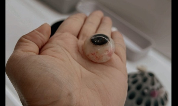 Eye Prosthetic Rehabilitation