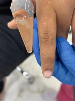 Prosthetic Nose Rehabilitation