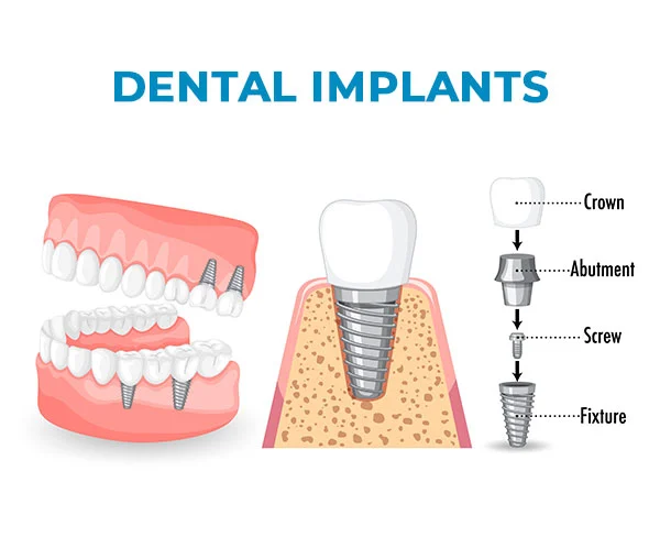 Types of Dental Implants